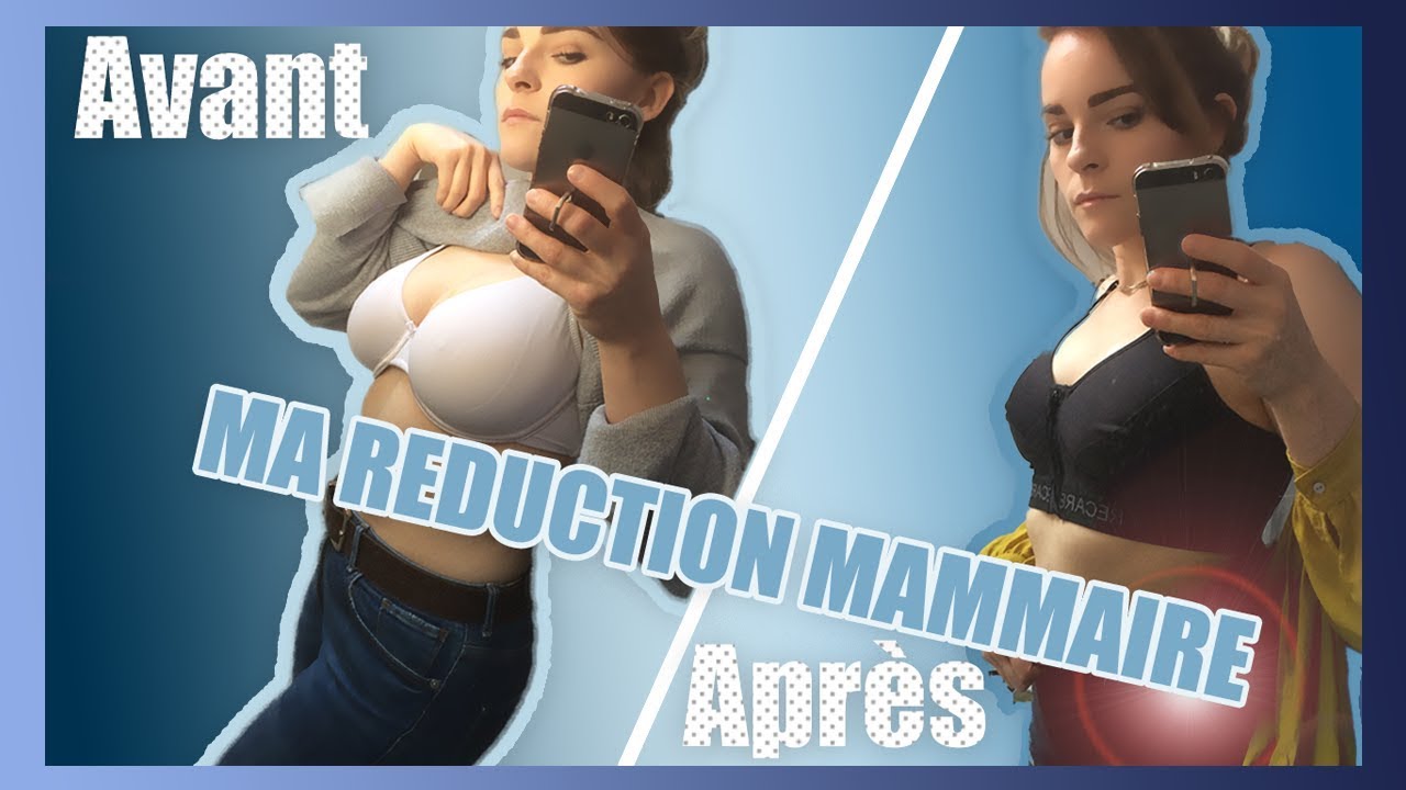 STORYTIME | J'ai subi une opération de réduction mammaire (AVANT/APRES)