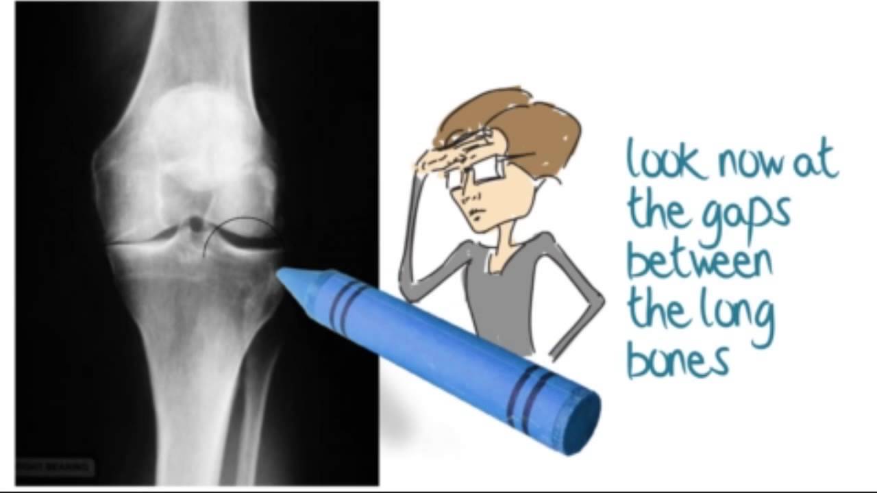 How to interpret knee X-rays - Part 1 - AP view