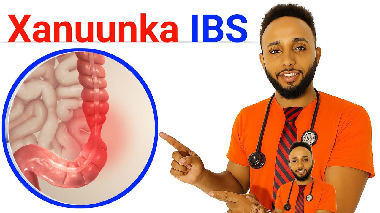 calaamadaha lagu garto in aad qabto cudurka looyaqaano IBS oo ku dhaca caloosha iyo mindhiciraha 