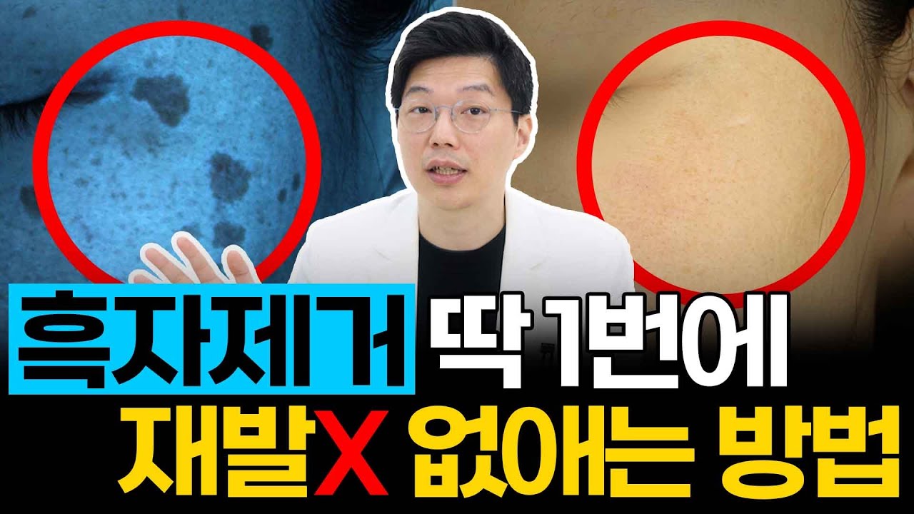 흑자제거 재발없이 딱 1번만에 없애는 방법 알려드릴게요 #흑자제거 #흑자 