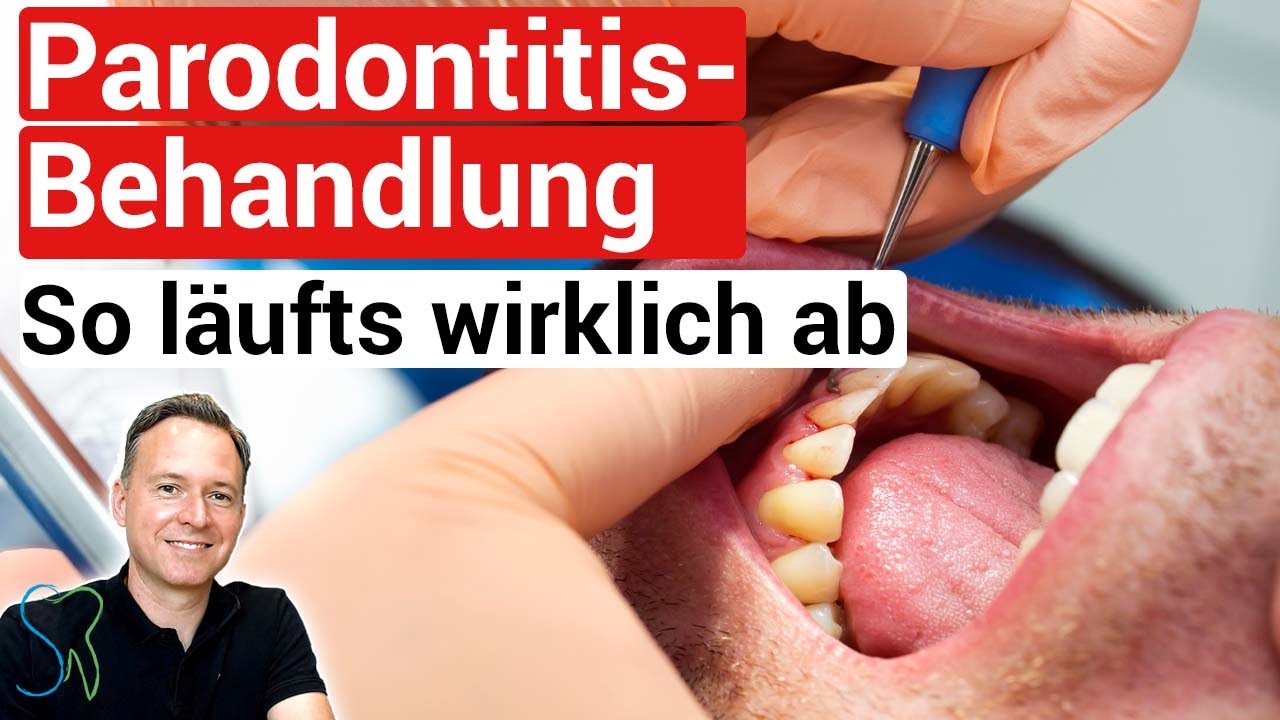 👉🏻So läuft eine Parodontitisbehandlung wirklich ab❗️