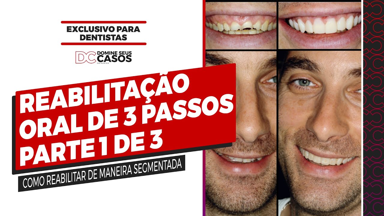 Reabilitação Oral Adesiva de 3 Passos em Dentes Desgastados- Parte 1