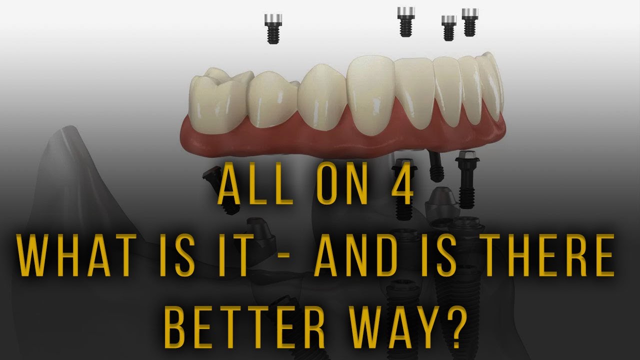 All on 4 - Is there a better way?