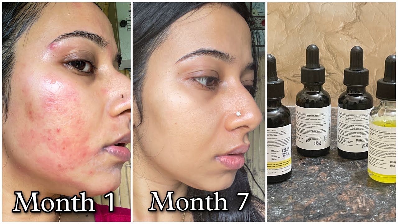 Best Face Serums that helped me to remove Pimple Marks, Acne Scars, Dark Spots, PIH & PIE