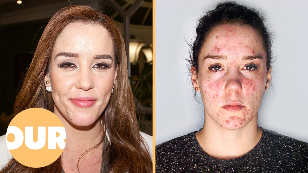 Severe Acne Is Ruining My Life | Our Life