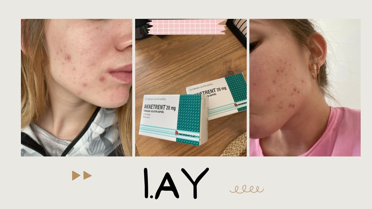 AKNETRENT | ROACCUTANE 1. AY SÜRECİM💊 HANGİ YAN ETKİLERİ OLDU?