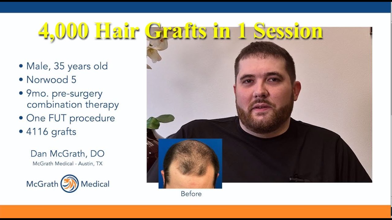 4,000 Graft Hair Transplant Testimonial - Austin, Texas