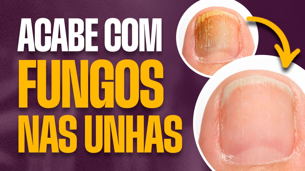 Melhores Óleos Essenciais para tratar fungos nas unhas
