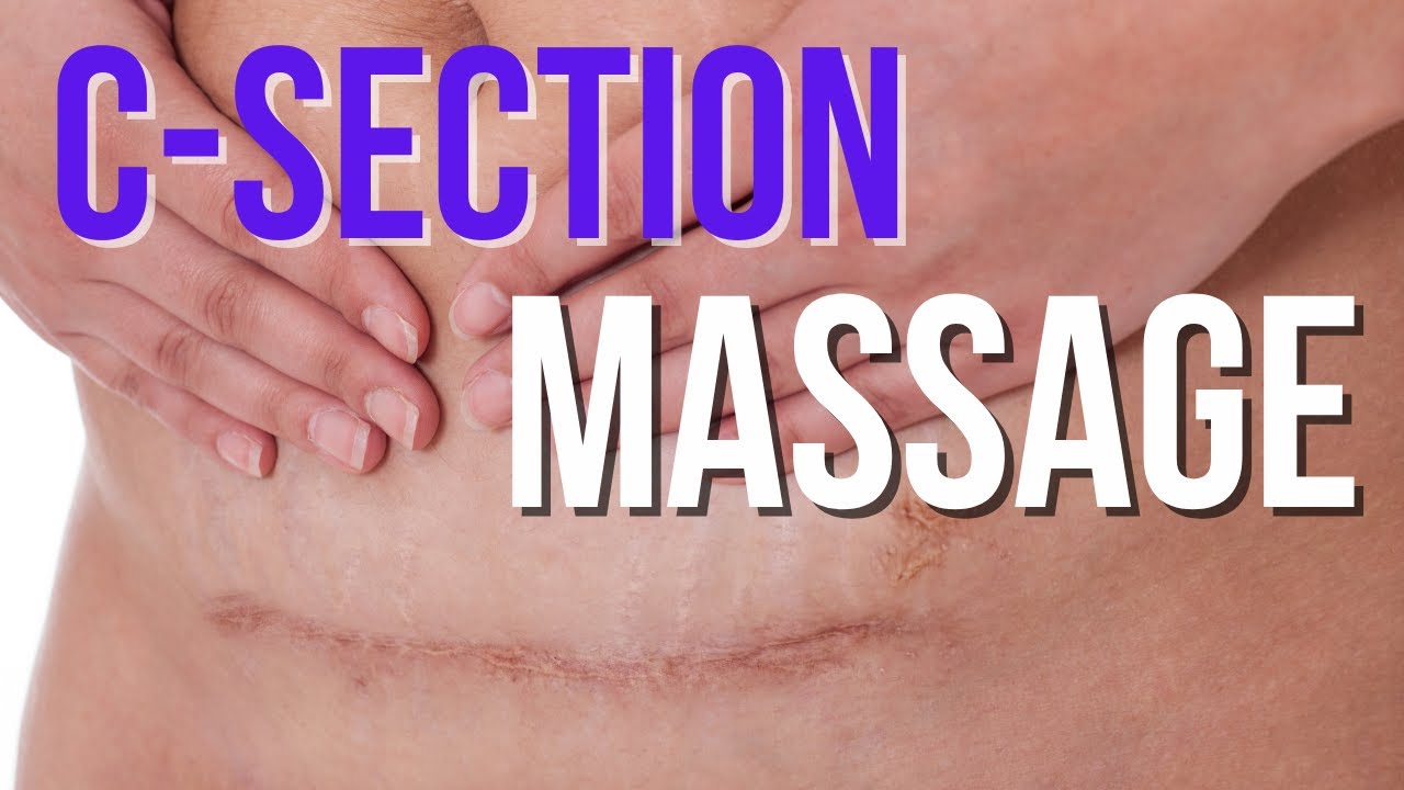 C-section care: how to massage your cesarean scar