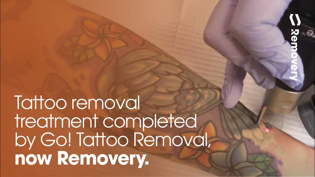 Laser Tattoo Removal On Forearm | Go Tattoo Removal, Now Removery