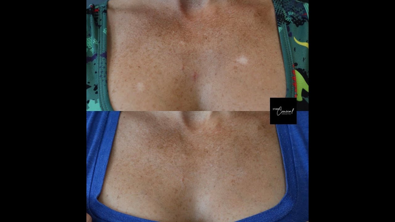 Hypopigmented Scar Revision - Camouflage Tattoo
