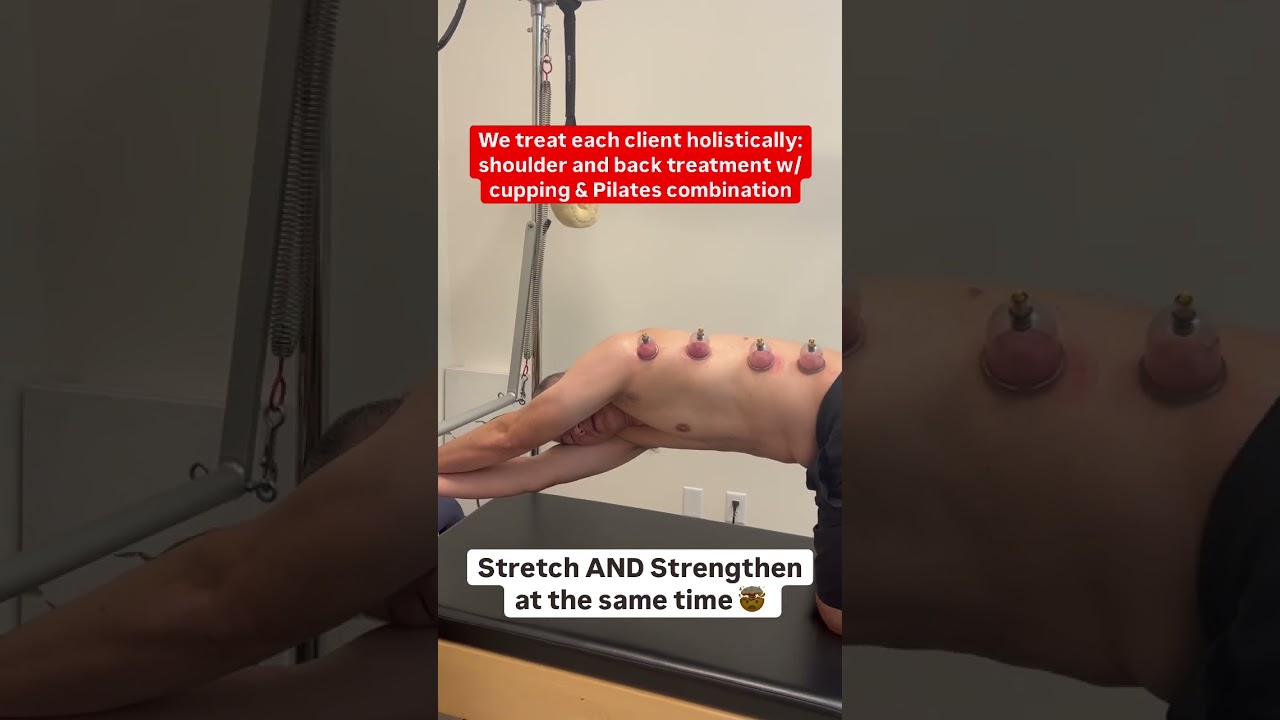 Cupping and Pilates for back pain treatment in San Ramon ￼