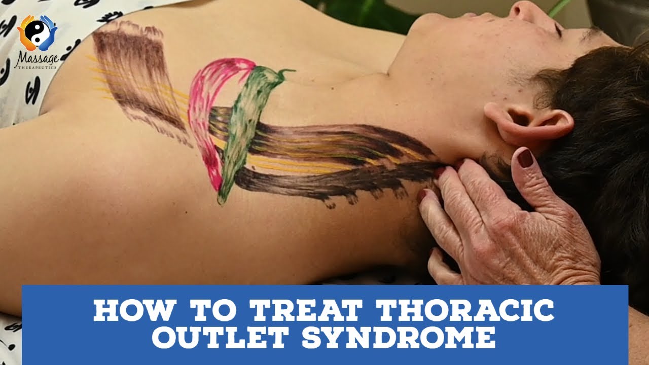 How to Treat Thoracic Outlet Syndrome