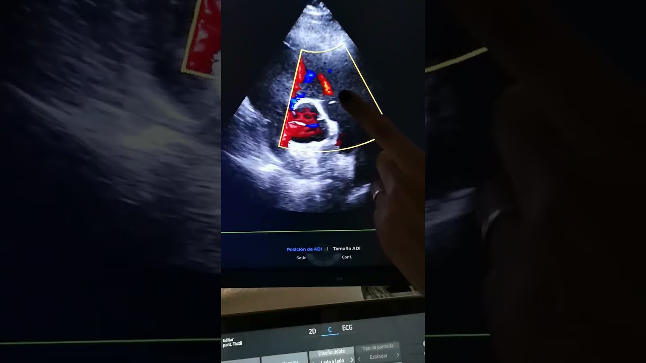 Adult Heart Assist en el V8. Único en Samsung!
