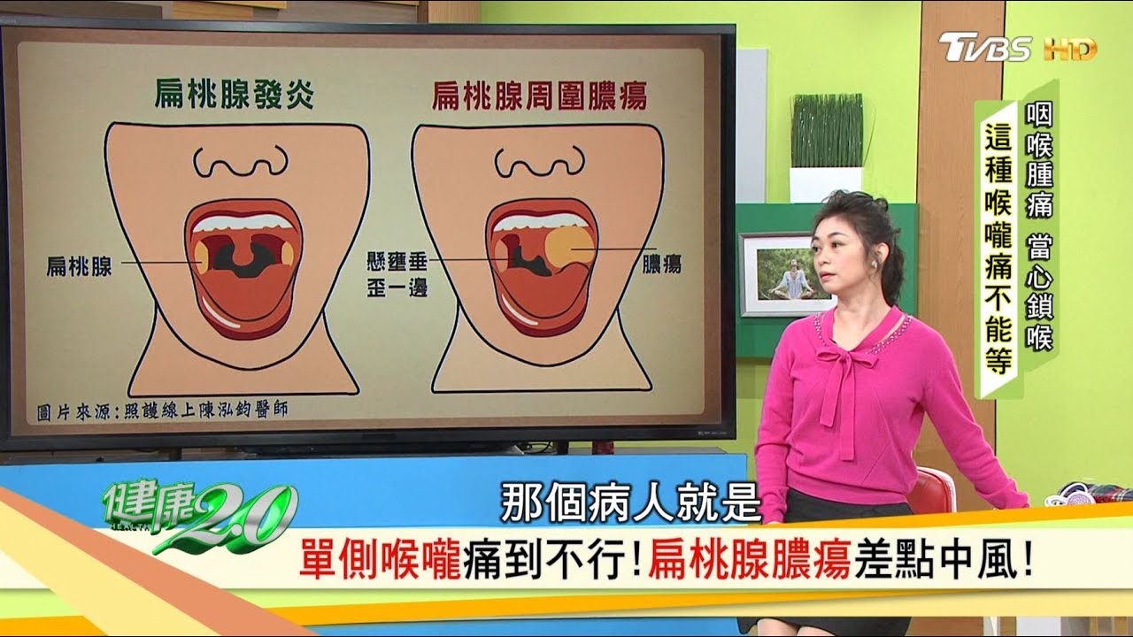 喉嚨痛傻傻分不清？扁桃腺反覆發炎，久久不治索性切掉扁桃腺！健康2.0