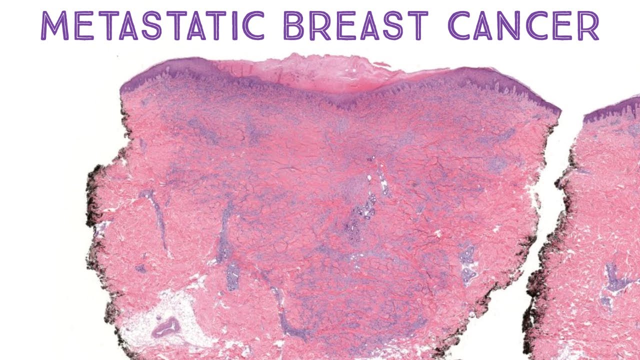 Metastatic Breast Cancer (mimicking granuloma annulare on pathology & dermatology!) (Emory case 3)
