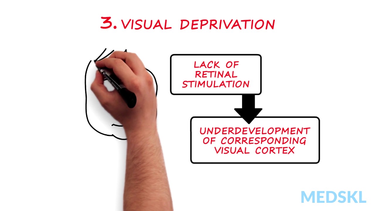 Ophthalmology – Amblyopia: By Christine Law M.D.