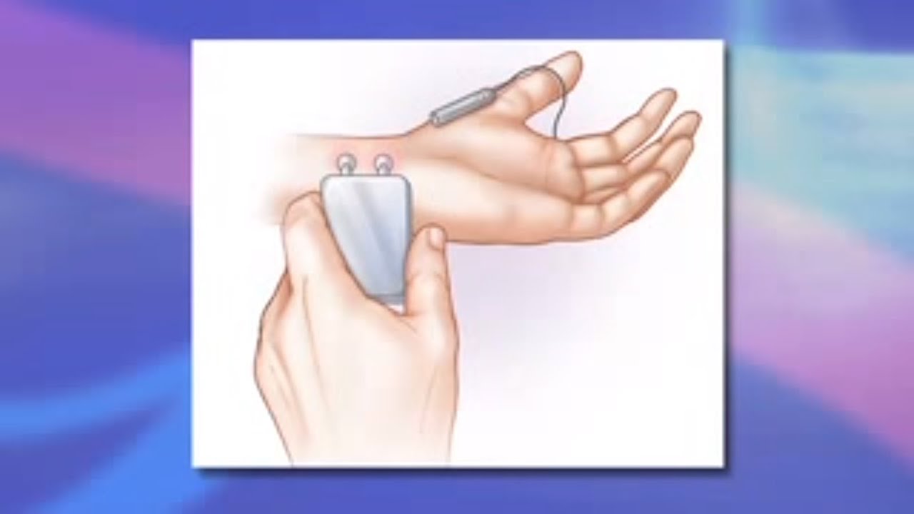 Thoracic Outlet Syndrome
