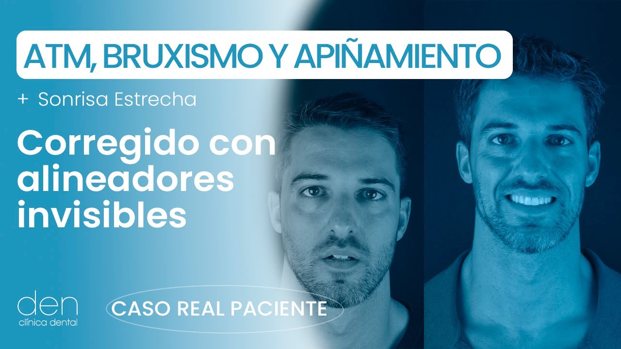 Tratamiento con Alineadores Invisibles: CASO REAL 🔴 ATM, Bruxismo, Sonrisa Estrecha y Apiñamiento