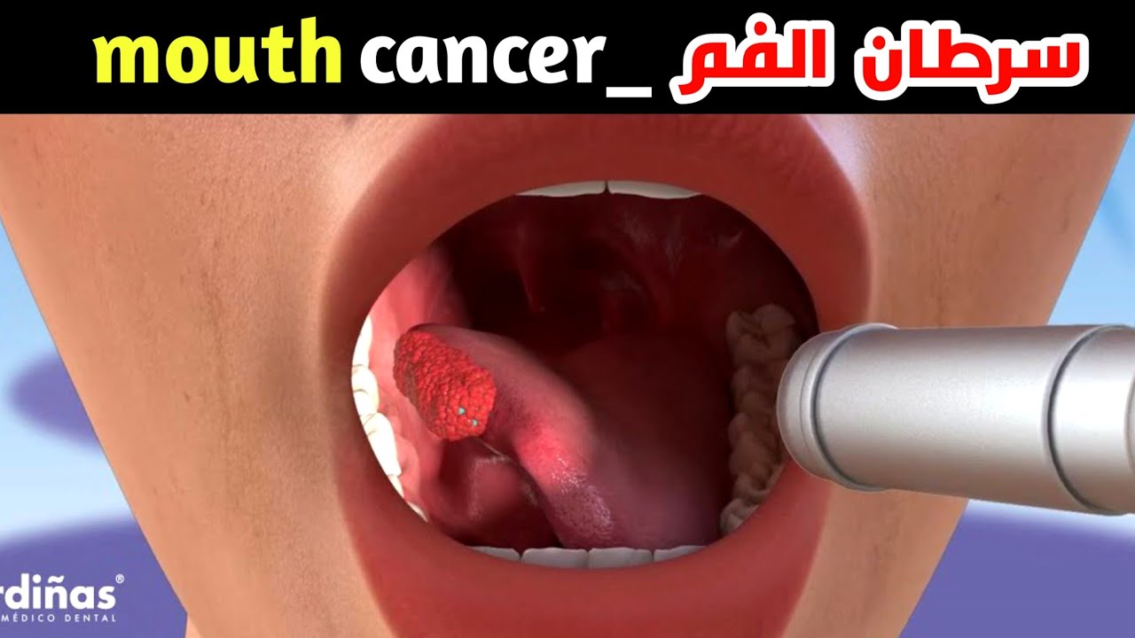 ماهو سرطان الفم وكيف يتم الكشف عنة وماهو علاجة؟؟_Oral cancer symptoms and treatment