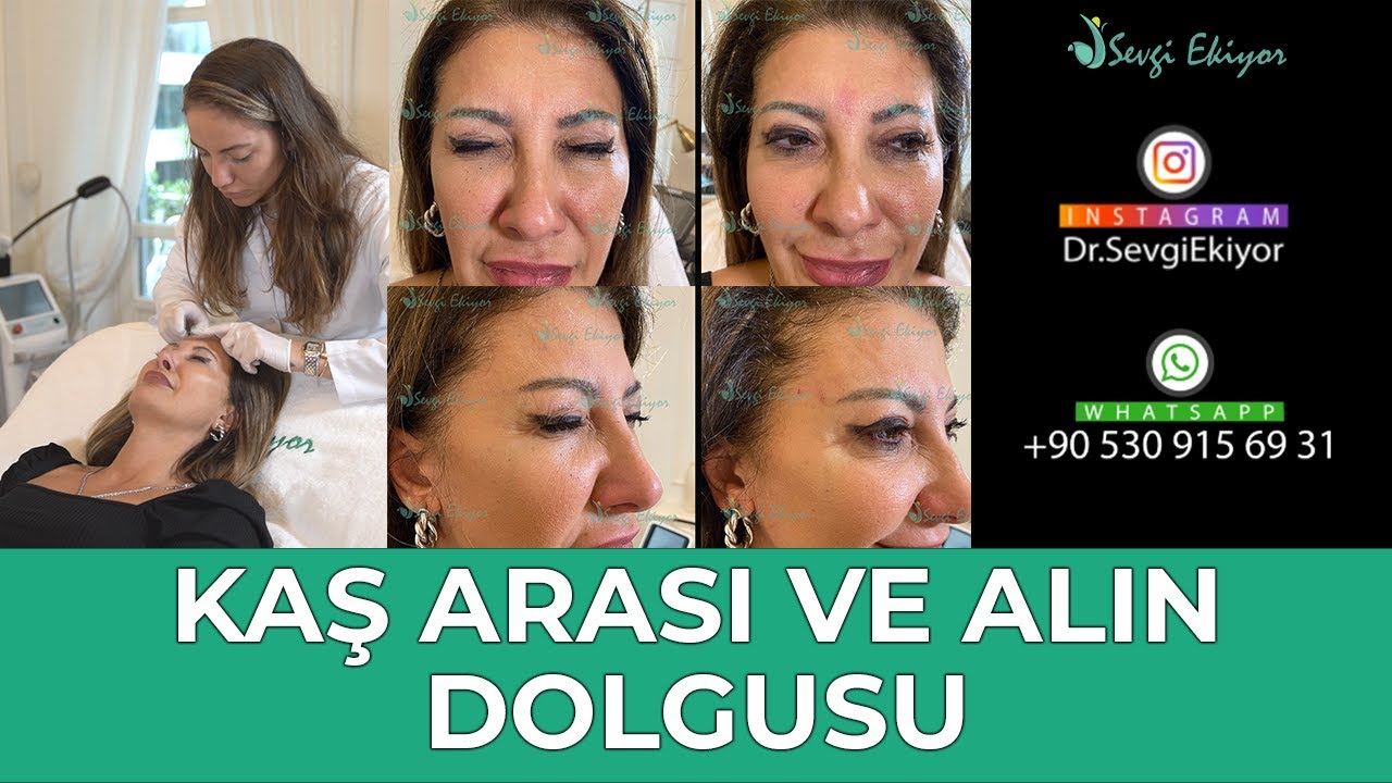 Kaş Arası Ve Alın Dolgusu