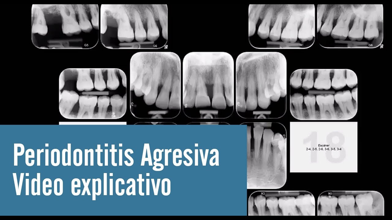 Periodontitis Agresiva / Video explicativo