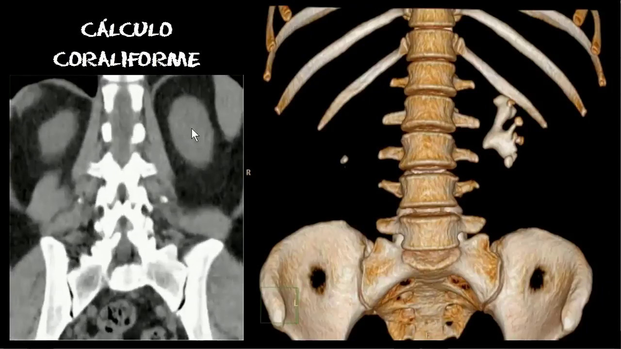 Cálculo coraliforme