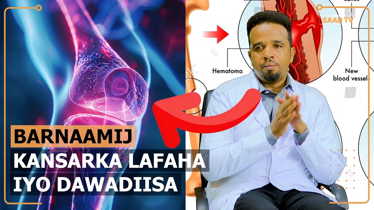 Halista uu leeyahay Kansarka ku dhaca Lafaha oo la soo bandhigay