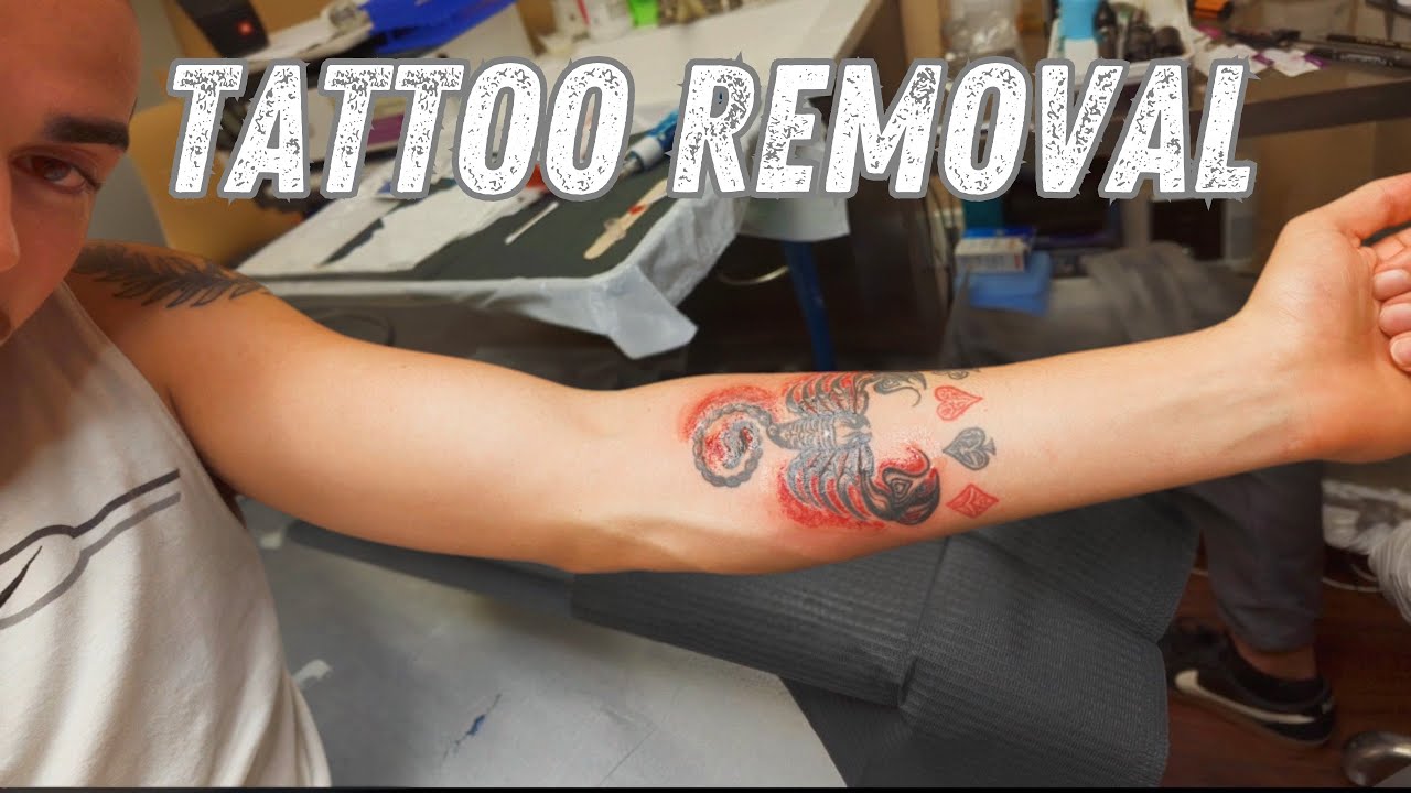 Why I chose SALINE TATTOO REMOVAL (VLOG) EP.32 #tattoo #tattooremoval