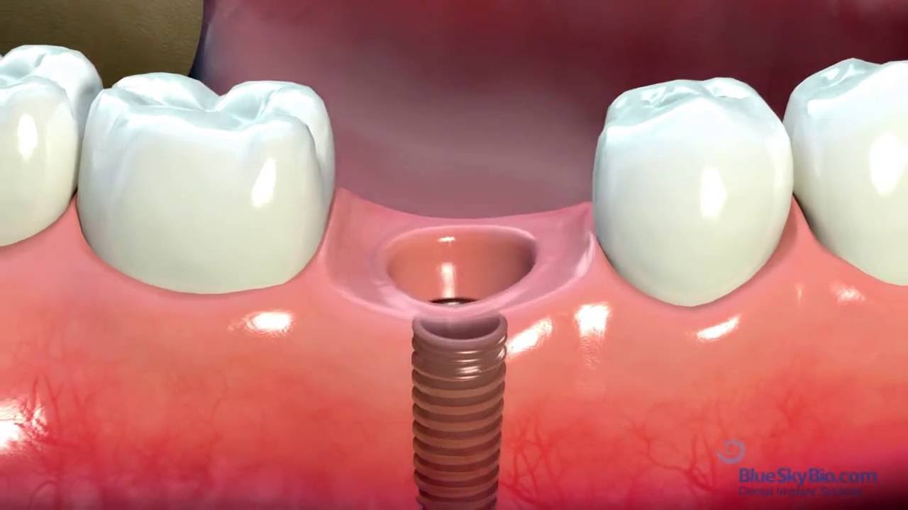 Dental Implants  - Australian Dentists Clinic