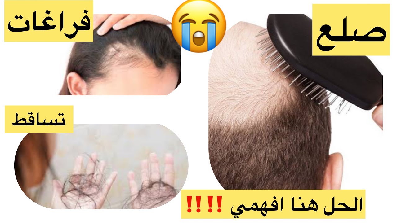اتعلمي واتخلصي من كل مشاكل الشعر حتي لو صلع 🧑‍🦲 فراغات تساقط او هيشان👍👍