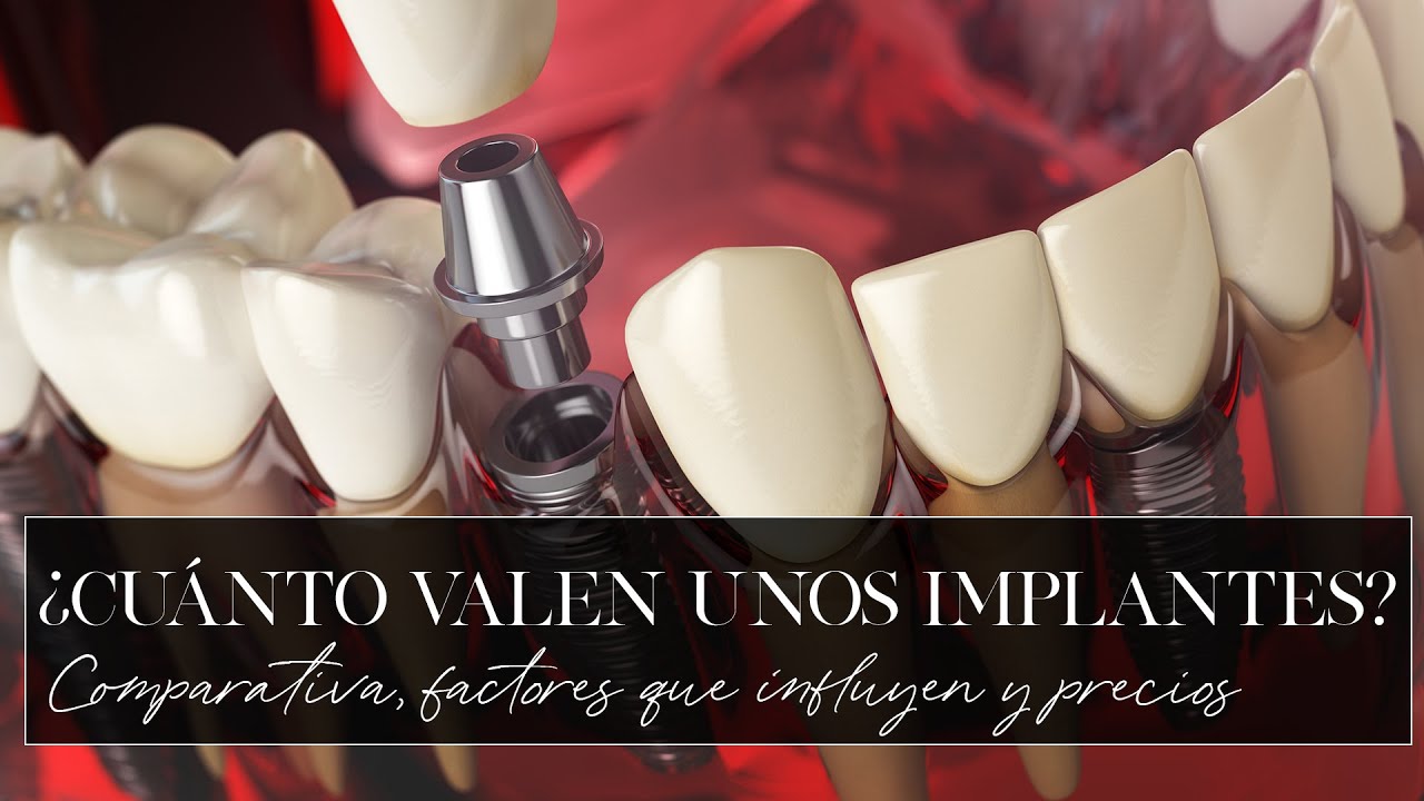 Precio Implantes 2023