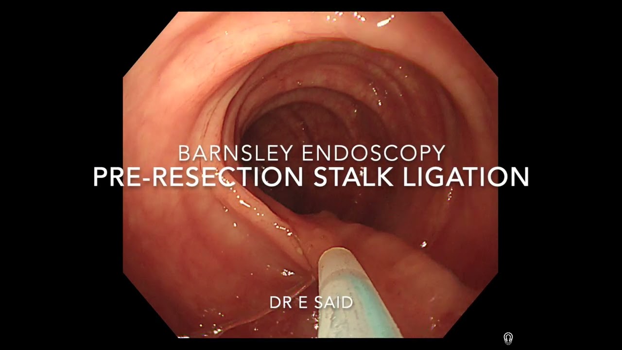 Pre-resection endoloop stalk ligation of 0-Ip polyps: