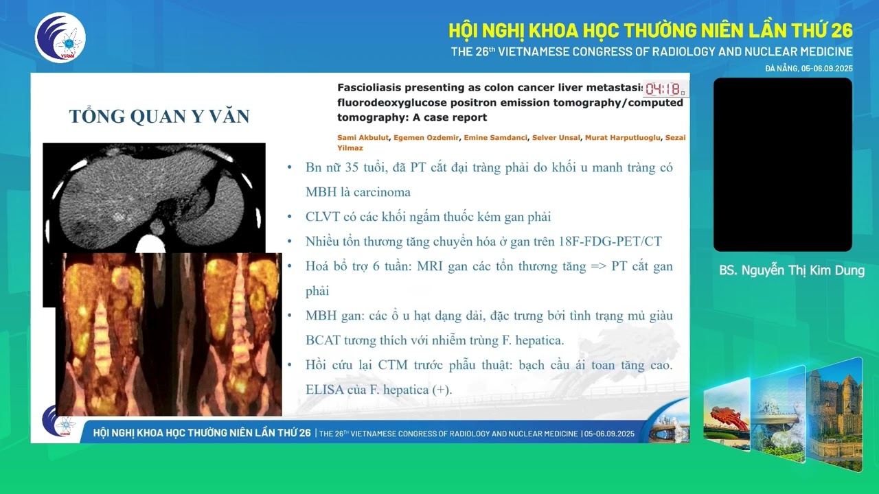 3. Tổn thương giả u ống tiêu hóa do sán lá gan lớn (ThS.BS. Nguyễn Thị Kim Dung)