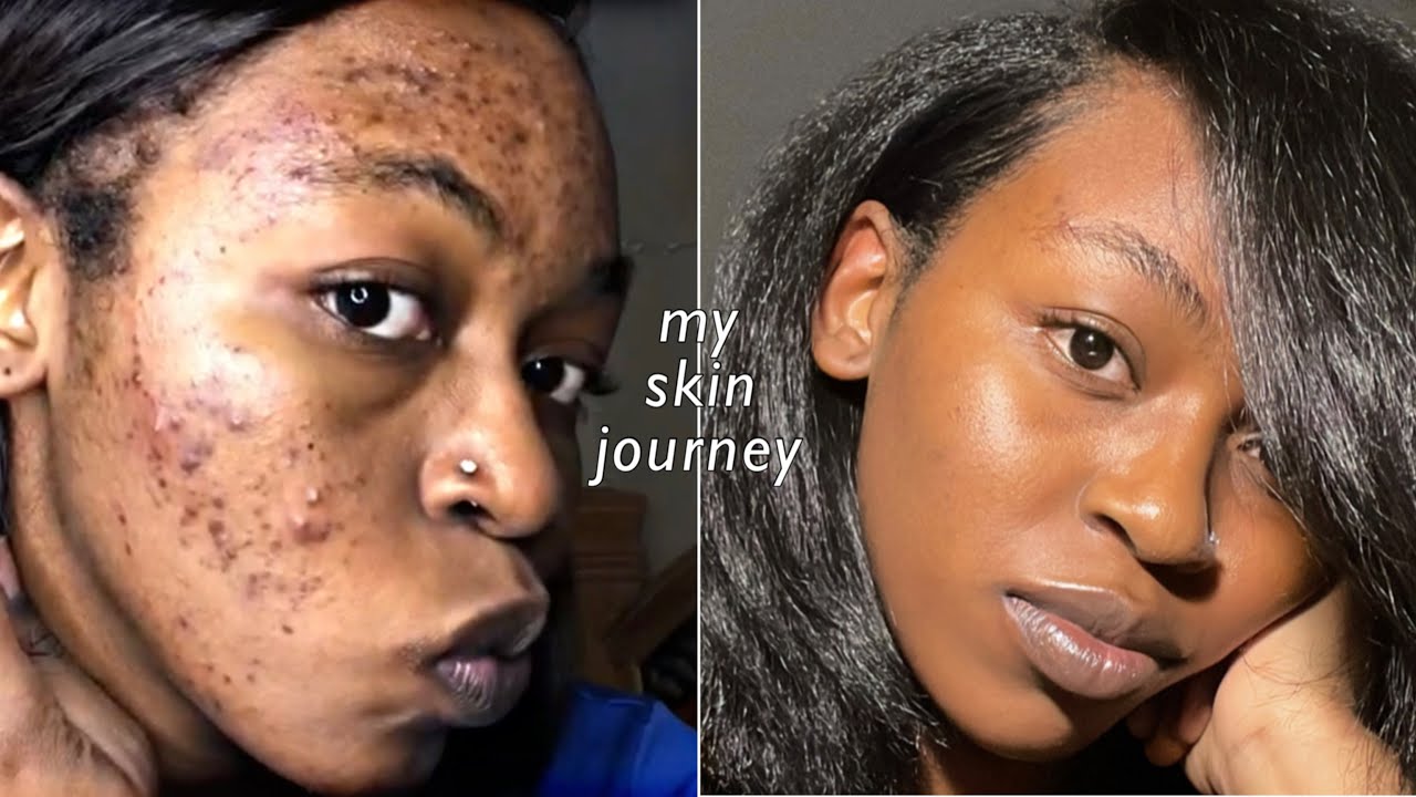 how Tretinoin saved my skin (pictures included)