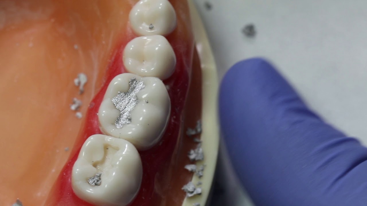 #30 Occlusal Amalgam Filling - Dr. James Keddington  (UofU SOD)