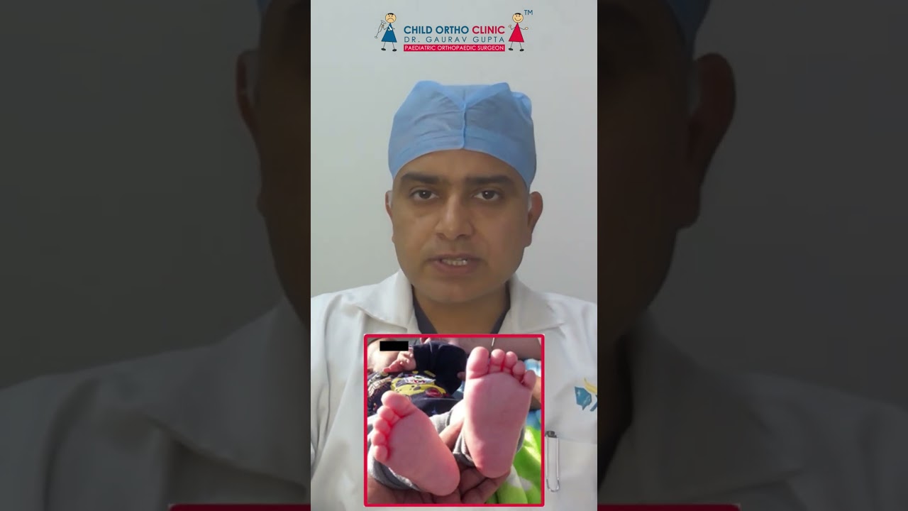 #clubfoot #treatments Dr. Gaurav Gupta