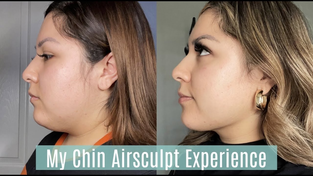 My Airsculpt Experience!! Is it worth it??