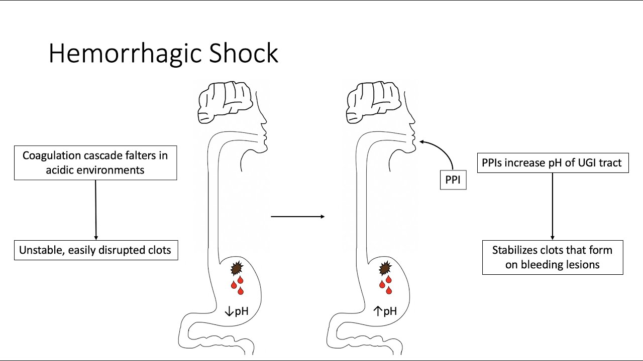 Hemorrhagic Shock