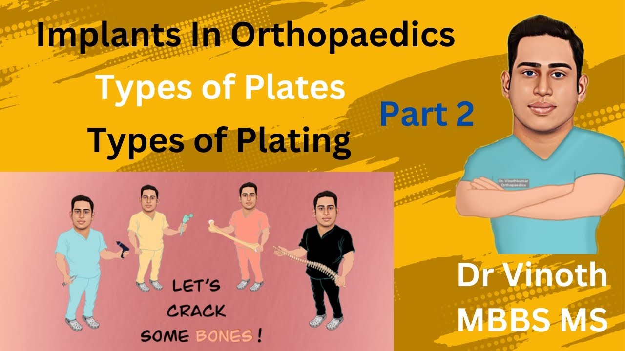 Plating in Orthopaedics| Types of Plating| Fracture plating types| Plates in Orthopaedics - DrVinoth