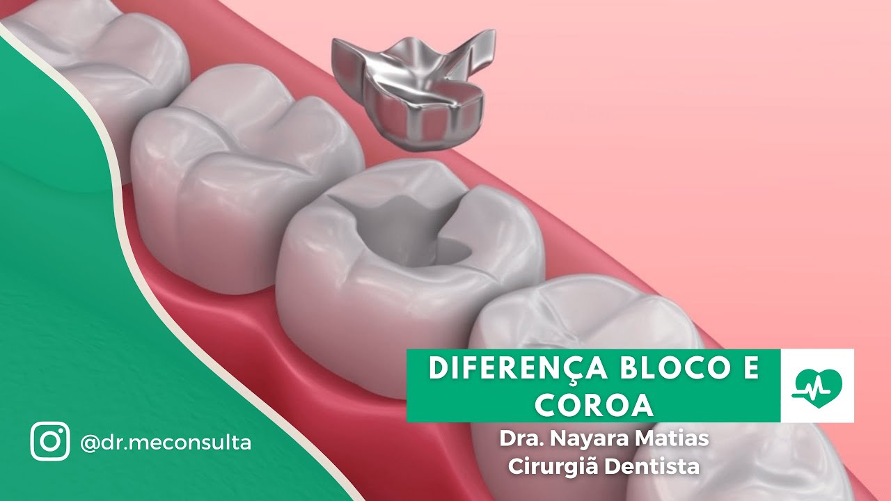 Bloco e coroa: Qual é a diferença?