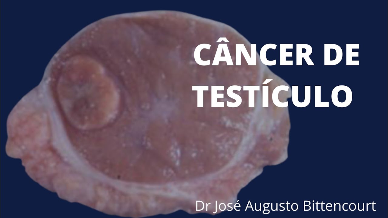 Qual a chance de cura do C&Acirc;NCER DE TEST&Iacute;CULO