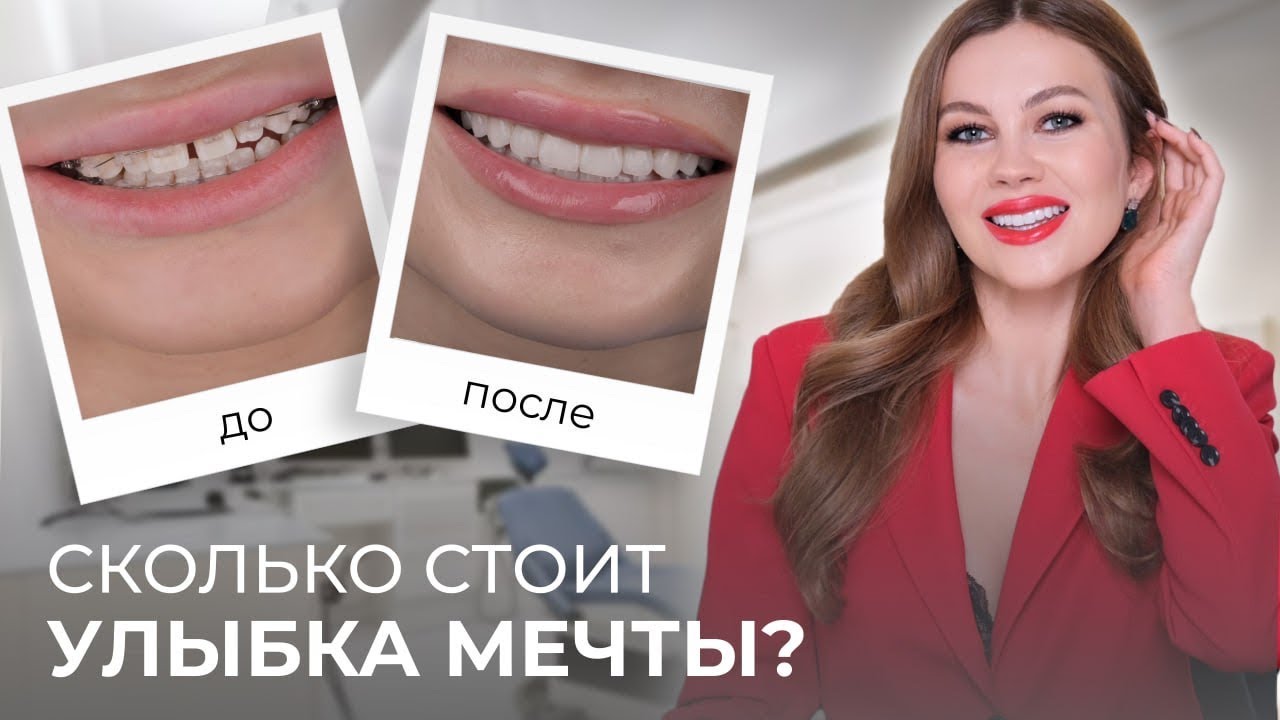 ШОК! ИЗМЕНИЛАСЬ ЗА ГОД |  БРЕКЕТЫ, ВИНИРЫ