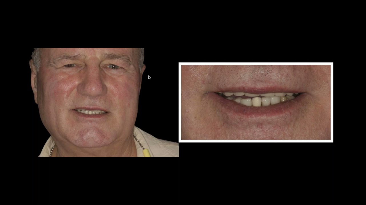 Control & Balance of Translucency & Opacity for Multiple Material Options with Peter Pizzi, CDT, MDT