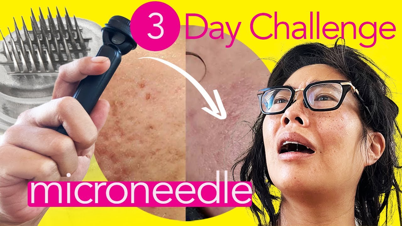 Microneedling 3 Days IN A ROW! Here's What Happened