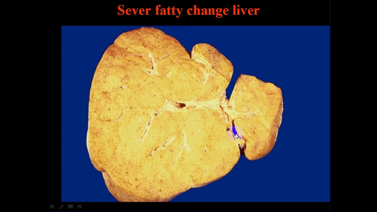 pathology - dr.nafea -- cellular accumulations & Adaptation