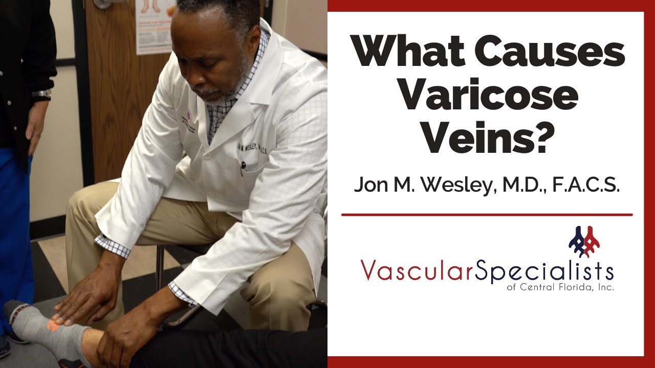 What Causes Varicose Veins?  | Vascular Specialists of Central Florida
