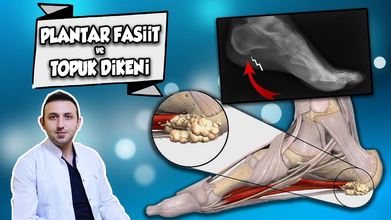 TOPUK DİKENİ Tedavisi ve Ağrıyı Yok Eden Egzersizler | Plantar Fasiit'e Kesin Çözüm (Fizyoterapist)