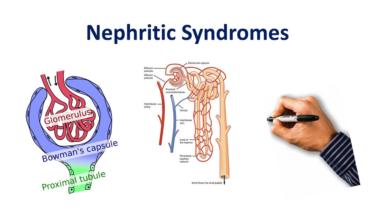 Nephritic Syndrome Made Simple!