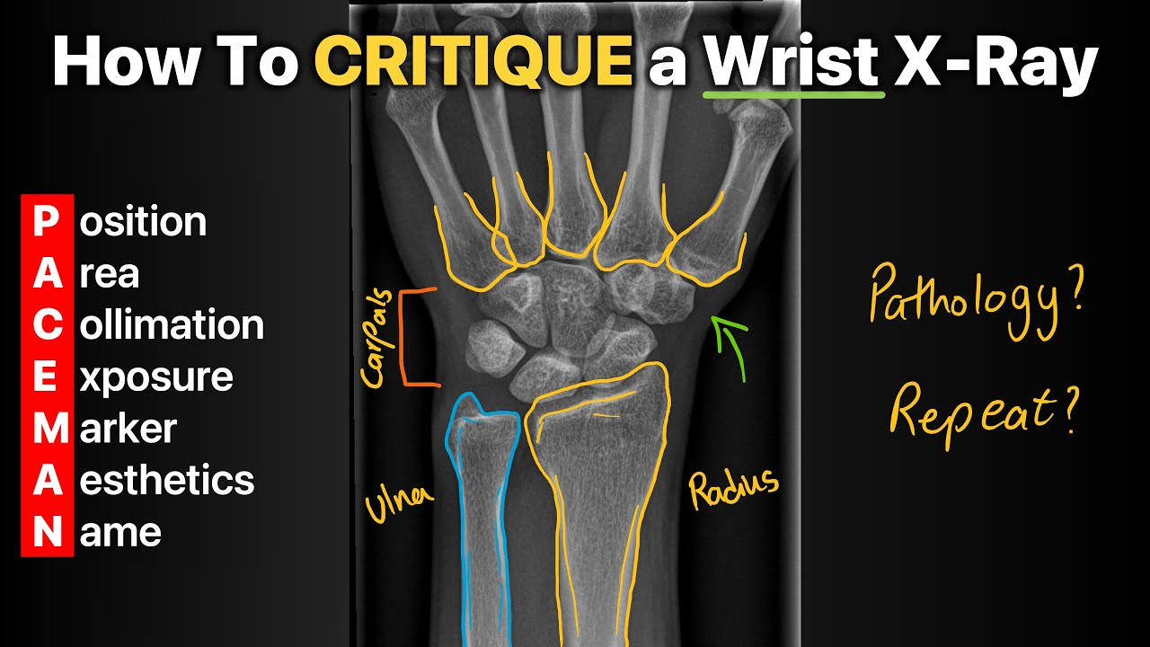 How to Critique a Wrist X-Ray!